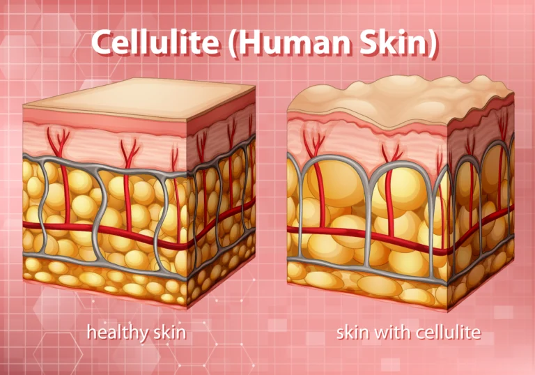 cellulite